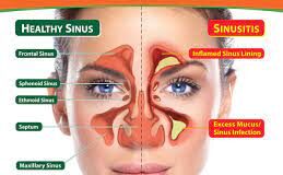 Known Facts About Sinusitis