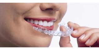 Invisalign Review