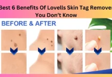 Best 6 Benefits Of Lovells Skin Tag Remover You Don’t Know